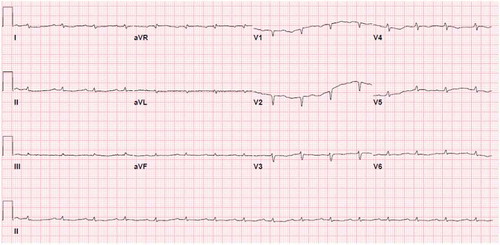 Figure 1. EKG showing diffuse low voltage QRS present in all leads