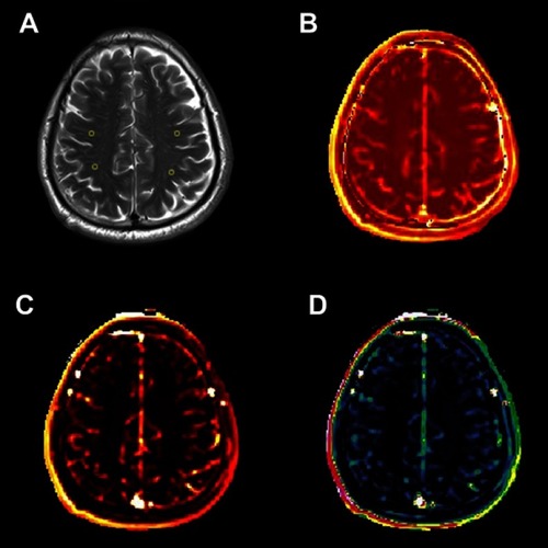 Figure 1 An example map in the CSO (×1). (A) Axial FLAIR image of a 67-year-old man and ROIs; (B) Ktrans map; (C) AUC map; (D) Vp map.Abbreviations: CSO, centrum semiovale; FLAIR, fluid-attenuated inversion recovery; ROIs, regions of interest; Ktrans, BBB leakage rate; BBB, blood–brain barrier; AUC, area under the leakage curve; Vp, fractional blood plasma volume.