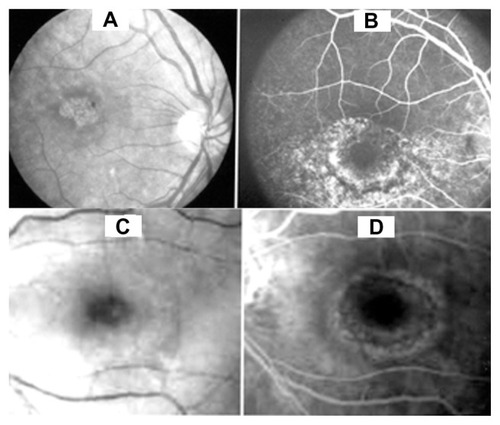 Figure 1 (A) Fundiscopic photo of the retina showing a target maculopathy in a patient with chloroquine retinopathy. (B) Fluorescein angiography of same case showing a fairly large area of dye leakage extending from the perimacular region. (C) Fundiscopic photo of the target maculopathy in a patient with hydroxychloroquine retinal toxicity. (D) Fluorescein angiography of this case shows a milder change than seen with chloroquine.
