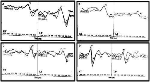Figure 3. Representative cVEMP waveforms: (A) A patient with normal P1 (RT = 15.33 ms; LT = 15.08 ms) and N1 (RT = 21.75; ms; LT = 21.76 ms) latencies, reduced amplitude on the RT side (43.82 µV) and normal on the LT (92.51 µV). AR is 35.71%. (B) A patient with normal P1 (RT = 15.25 ms; LT = 14.67 ms) and N1 (RT = 20.67; ms; LT = 22.67 ms) latencies, reduced amplitude on the LT side (20.39 µV) and normal on the RT (90.73 µV). AR is 63.30%. (C) A patient with longer RT P1 (RT = 18.08 ms; LT = 13.00 ms) and RT N1 (RT = 24.25; ms; LT = 22.75 ms) latencies and normal amplitudes (RT: = 71.17 µV; LT = 69.95 µV). AR is 0.86%. (D) A healthy subject with normal P1 (RT = 14.00 ms; LT = 14.60 ms) and N1 (RT = 20.03 ms; LT = 22.33 ms) latencies and amplitudes (RT = 102.18 µV; LT = 84.11 µV). AR is 9.70%.
