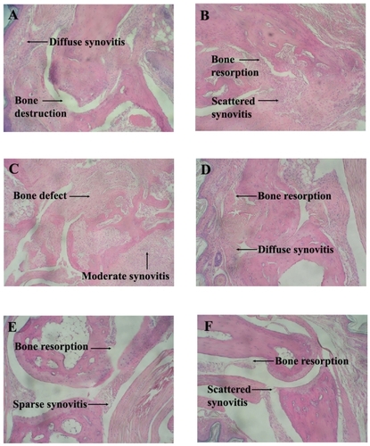 Figure 5 Histology photomicrographs of Hematoxylin and Eosin stained joints of mice with collagen induced arthritis. A. Vehicle control with diffuse synovitis and bone destruction. B. CDP with scattered synovitis and bone resorption. C. Free MP (0.01 mg/kg/day) with moderate synovitis and full thickness bone defect. D. Free MP (0.1 mg/kg/day) with diffuse synovitis and bone resorption. E. CDP-MP (0.7 mg/kg/week) with sparse synovitis and small area of bone resorption F. CDP-MP (7 mg/kg/week) with scattered synovitis and small area of bone resorption.