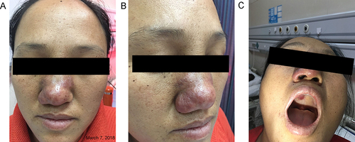 Figure 1 (A-C) Erythematous, infiltrating plaques on the patient’s nose and upper jaw.