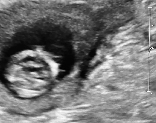 Figure 4 First-trimester septated cystic hygroma in 40 year-old, P2 at 11 and 5/7 weeks’ gestation. Despite the suboptimal resolution, note the clear thin projecting septations. Non-invasive prenatal screening revealed increased risk of Trisomy 18. Despite extensive counseling the patient declined amniocentesis and elected to continue her pregnancy. Mid-trimester sonography noted: hypotelorism, bilateral clenched hands, spinal column deformity, and large bi-directional ventricular septal defect (VSD). At repeat Cesarean due to SROM and labor at 37 weeks’ gestation, a growth-restricted male neonate weighing 1775 gram was delivered. The neonate manifested dysmorphic features and structural congenital cardiac defects consistent with Trisomy 18, which was confirmed by neonatal karyotyping. The infant later succumbed at three months of life.