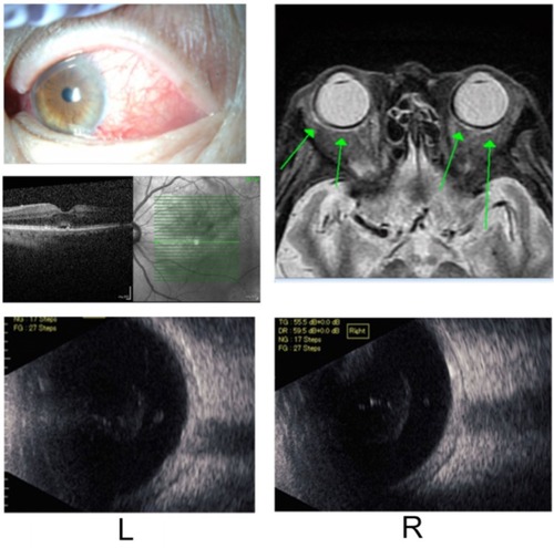 Figure 5 Ocular findings after scleritis.