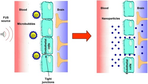 Figure 3 Scheme of brain delivery of nanoparticles with focused ultrasound (FUS) technique.Abbreviation: SF6, sulfur hexafluoride.