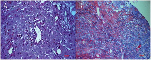 Figure 7. Implanted chondro-Kpro in rabbit 4. A. Light micrograph of the membrane over the anterior plate, eosinophils were demonstrated diffusely in the tissue (HE); B. Light micrograph of the membrane over the anterior plate, both collagen and keratin were demonstrated (Masson’s trichrome stain).