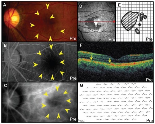 Figure 1 The left eye before treatment in a patient with acute macular neuroretinopathy: (A) fundus photograph shows a wedge-shaped, dark, reddish-brown lesion (indicated by arrows) in the macula; (B) fluorescein angiography in the late phase and (C) indocyanine green angiography in the initial phase show a hypofluorescence corresponding to the lesion (indicated by arrows); (D) scanning laser ophthalmoscope infrared imaging shows the dark area; (E) Amsler chart shows scotomata corresponding to the acute macular neuroretinopathy lesion; (F) horizontal image of optical coherence tomography through the fovea (indicated by arrow of figure 1D) shows a disruption of the photoreceptor inner segment–outer segment junction (indicated by arrows) and thinning of the outer nuclear layer corresponding to the lesion; (G) in multifocal electroretinography, decreased amplitude was present at the posterior pole, extending especially from the central fovea toward the nasal side.