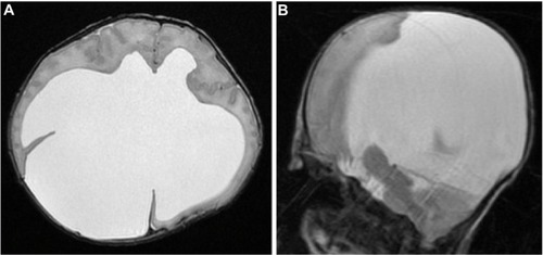 Figure 2 Axial (A) and sagittal (B) T2-weighted magnetic resonance images reveal a huge interhemispheric cyst-associated ventriculomegaly and agenesis of the corpus callosum.