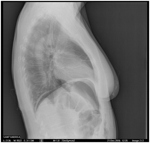 Figure 2. X-ray showing moderate levels of sub-diaphragmatic free gas, prevalently to the left side.