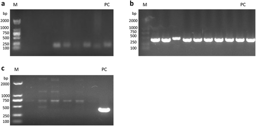 Figure 1. Detection of HPV-DNA in the peripheral blood of patients with non-small cell lung cancer. (a)HPV universal primer amplification electrophoresis map; (b)HPV16-specific primer amplification electropherogram; (c)HPV18-specific primer amplification electropherogram. Note: M: marker; PC: positive control