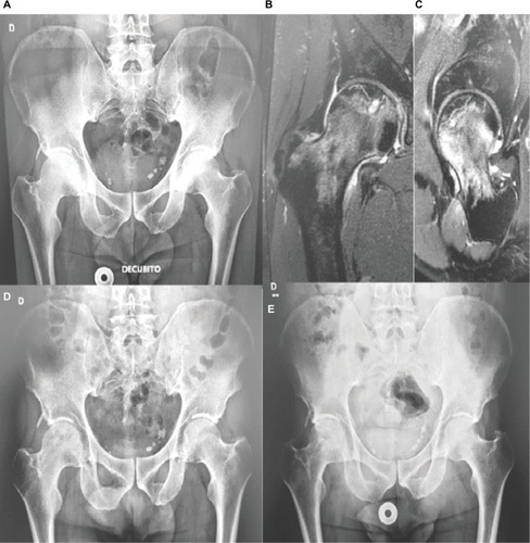 Figure 2 X-ray and/or MRI images of the pelvis of an AVN patient (#3) at inclusion in the study (A, B, C), immediately after the cell infusion (D) and after a 3-year followup period (E).