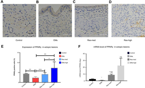 Figure6 Resveratrol induced PPARγ activation in ectopic focus of EMs rats. (A–D) Immunohistological staining of PPARγ expression. PPARγ expression in stromal cells in Control (A), EMs group (B), Res-med group (C) and Res-high group (D) as well as weak staining in surface epithelial cells in EMs group (B), Res-med group (C). Strong staining of PPARγ expression in glandular epithelial cells was showed in the lesion tissues of model rats after resveratrol treatment compared to the untreated EMs groups (D). (E) Immunohistological PPARγ expression levels were semiquantitatively analyzed by counting of positive and total cell number of the epithelial and stromal cells. The percentages of positive cells/total cells are shown. (F) Effects of resveratrol on PPARγ mRNA expression. PPARγ mRNA transcripts normalized to β-actin expression were quantified in real-time. Scale bar: 100 μm. Data are presented as mean ± SEM. *P < 0.05; **P < 0.01 and ***P < 0.001 EMs vs control; #P< 0.05, ##P< 0.01 Res-high vs control (ANOVA).