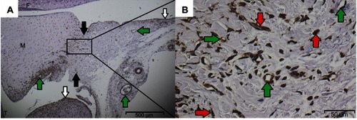Figure 8 (A) Overview of the histological sagittal section of the posterior knee joint with femur (F), tibia (T), meniscus (M), αSMA-positive vessels (green arrows), superior and inferior capsular regions (black arrows) and synovial lining (white arrows). (B) Detailed view of the central region behind the meniscus, in which the 361.4×268.5 µm counting field was placed. αSMA-positive cells appear brown and either belong to vessels (green arrows) or are defined as myofibroblasts (red arrows).
