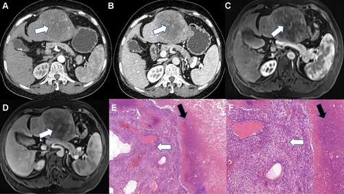 Figure 3 Macrotrabecular-massive HCC. The tumor showed markedly hypo- or no enhancement area (White arrow) in the arterial phase (A) and portal phase (B) on contrast-enhanced CT, representing ischemia or necrosis. Ischemia or necrosis (White arrow) appears as hypo- or no enhancement in arterial phase (C) and portal phase (D) on MRI. Neoplastic cells of MTM-HCC showed trabecular architecture (White arrow) and Obvious necrosis (Black arrow) (HES, x100) (E) Trabecular architecture (White arrow) and numerous necrotic foci (White arrow) were observed in this case (HES, x200) (F).