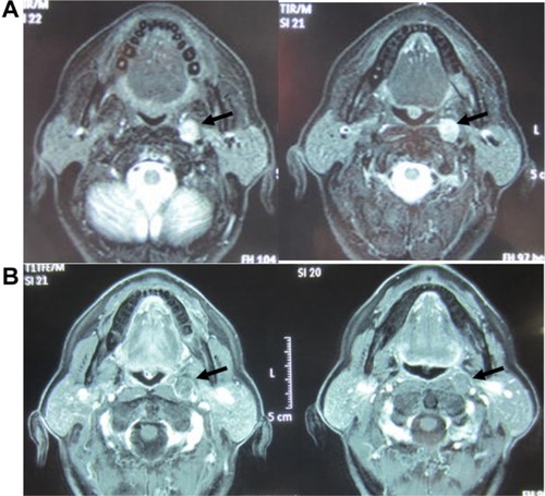 Figure 2 MRIs of a recurrent retropharyngeal node from hypopharyngeal carcinoma. (A) T2-weighted MRI shows a left recurrent retropharyngeal node (arrow). (B) MRI with fat suppression enhances only marginal zone of the tumor (arrow).