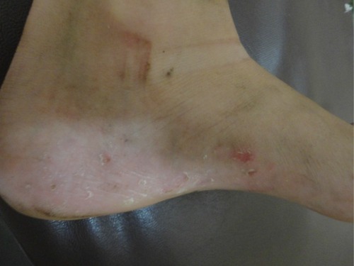 Figure 1 Vesicles, keratosis and fissures on the foot beyond the plantar region.