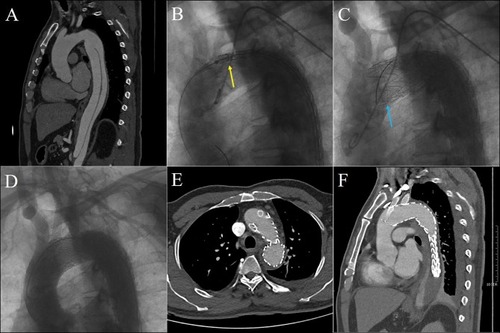 Figure 1 Chimney stent was deployed as a bailout to reconstruct the LCCA. TBAD was confirmed by preoperative CTA (A). The aortic stent-graft was planned to deploy between LCCA and LSA (yellow arrow) (B), but the ostia of LCCA was partially covered (blue arrow) accidentally (C). Double chimney technique (LCCA + LSA) was conducted (D), and postoperative CTA showed that both chimney stents were patent without endoleak at 6 months follow-up (E and F).