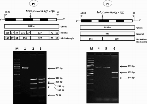 Figure 2. Identification of the Hb G-Georgia and Hb Nakhon Ratchasima mutations by PCR-RFLP assays using MspI and SalI digestion, respectively. The locations and orientations of primers αG39 and C3 and the size of amplified α2-globin gene fragment (883 bp) are illustrated. The sizes of MspI and SalI-digested fragments specific for αG-Georgia (258 bp) and αNakhon Ratchasima (539 bp and 344 bp) and their normal counterparts are indicated. In agarose gel electrophoresis, M represents the GeneRuler 50 bp DNA ladders. 1 and 4: undigested amplified DNA, 2: MspI-digested amplified DNA of normal subject, 3: MspI-digested amplified DNA of the P1 with Hb G-Georgia/α0-thalassemia, 5: SalI-digested amplified DNA of normal subject, 6: SalI-digested amplified DNA of the P2 with Hb Nakhon Ratchasima/α0-thalassemia.