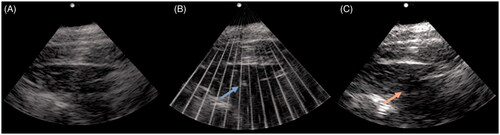 Figure 1. Axial US images pre (A), during (B), and post (C) histotripsy treatment of the targeted tissue in the anterior neck. The echogenic bubble cloud (blue arrow in B) is visible during histotripsy treatment for intraprocedural monitoring. Post procedure US image (C) demonstrates a hypoechoic treatment zone.