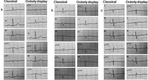 Figure 2. Electrocardiograms of limb leads in classical display and orderly display. (a) Note: representative electrocardiograms of normal axis. (b) Note: representative electrocardiograms of left-deviated axis. (c) Note: representative electrocardiograms of right-deviated axis.