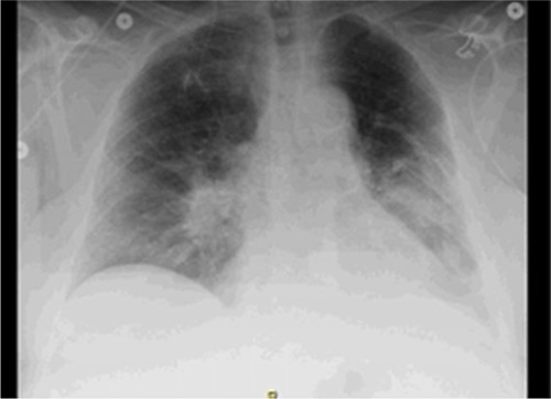 Figure 1 Chest X-ray showed an infiltrative process in the left lower lung field and a left sided pleural effusion.