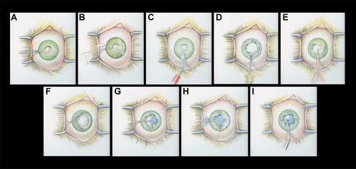 Figure 1 The right eye from the surgeon’s perspective depicting pupillary miosis and a dense, mature cataract. A standardized technique was used to create a continuous curvilinear capsulorhexis (CCC). (A): 1mm corneal paracentesis. (B): Methylparaben free xylocaine was injected intracamerally to numb the iris then cohesive viscoelastic was used to fill the anterior chamber. (C): 2.4mm temporal clear corneal incision with a microkeratome blade. Posterior synechiae, if present, were broken with a collar button. (D): A 6.25mm malyugin ring was placed to expand the pupil. (E): Cohesive viscoelastic was then removed via an irrigating/aspiration tip. (F): A small amount of viscoelastic was then used to seal the paracentesis. A 27-gauge cannula was then used to inject air through the paracentesis. If air was leaking through the temporal corneal wound, a temporary single 10–0 nylon could be placed in the incision. (G): Trypan blue was then injected through the paracentesis to stain the anterior capsule. (H): The air bubble and trypan blue were subsequently removed by filling the anterior chamber with a dispersive viscoelastic through the paracentesis. (I): The 10–0 nylon suture was removed from the temporal incision if it was previously placed. A ~5mm CCC was initiated with a cystotome and completed using Utrata Forceps.