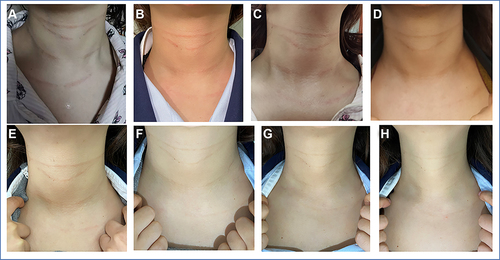 Figure 1 Changes in neck erythema in the patient. (A). Neck erythema on the 1st day; (B). Neck erythema on the 2nd day; (C). Neck erythema on the 3rd day; (D). Neck erythema on the 4th day; (E). Neck erythema on the 5th day; (F). Neck erythema on the Day 8; (G). Neck erythema on day 10; (H). Neck erythema on day 14.