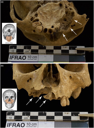 Figure 2. Periapical cavity in a young adult female. Pathological bone changes are consistent with a response to infection affecting the anterior right maxilla with lesions penetrating into the right maxillary sinus (indicated by white arrows). (a) Inferior view of maxilla. (b) Frontal view of maxilla.