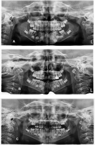 Figure 1 Panoramic examples of all the severity of ectopic eruption (A) An example of severe ectopic eruption maxillary right first permanent molar causing severe resorption to maxillary right second primary molar. (B) An example of moderate ectopic eruption maxillary left first permanent molar causing resorption of the dentine without pulp exposure (C) An example of mild ectopic eruption maxillary right first permanent molar with limited resorption to the cementum to maxillary right second primary molar.