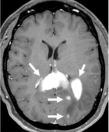 Figure 1 MRI Imaging at Second Relapse. Contrast enhanced axial MRI showing infiltrative, multifocal, enhancing mass lesions with one of the larger components centered within the splenium of the corpus callosum.