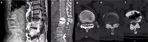 Figure 4 Preoperative x-ray and MRI showed previous L2-5 PLIF (a) and L12 ASD (b). Preoperative CT showed L12 ASD (c), T10-12 LCS, and OLF (d–f).
