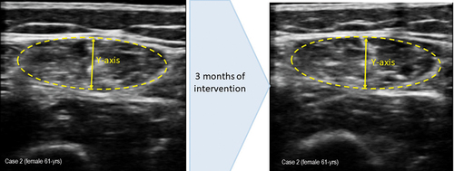 Figure 2. (a) measurement of muscle ultrasound images before intervention. Muscle thickness (Y-axis): 1.01 cm; muscle is in cm2: 2.72. (b) measurement of muscle ultrasound images at 3 month of intervention. Muscle thickness (Y-axis): 0.94 cm; muscle is in cm2: 2.78.