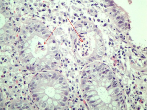Figure 1 Mixed type inflammatory cells in the lamina propria, distortion of crypt architecture, and frank crypt abscesses (arrows).