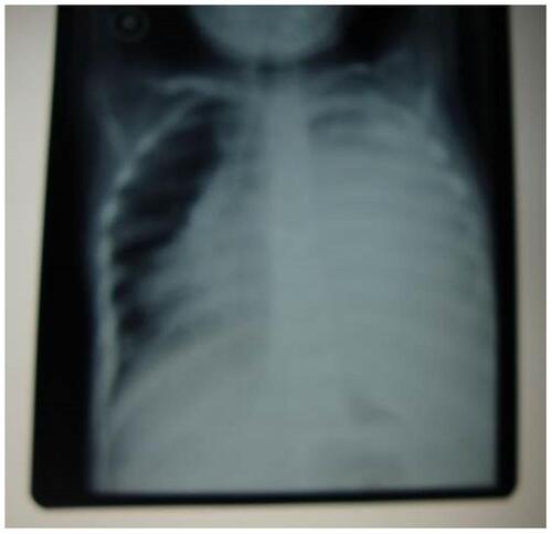Figure 3 The plain X-ray of the patient’s chest showed pleural effusion.