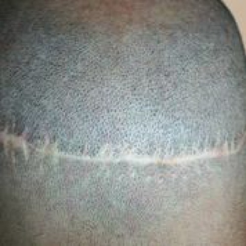 Figure 5 Pre-operative photograph of a patient with an old strip harvest scar. Note: This photo is reproduced courtesy of Vinci Hair Clinic.