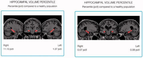 Figure 2. Regional analysis showing the Hippocampal Volume Percentile by highlighting the hippocampus in the healthy brain (left) and the AD brain (right).