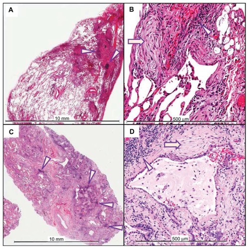 Figure 1 Hematoxylin and eosin staining of SLB (A and B; scales indicated in each panel) and lung explant (C and D) from a typical patient with a 25 month interval between procedures.Notes: Both the SLB and explant demonstrate a pathologic pattern of UIP, characterized by a patchwork pattern of fibrosis, architectural distortion, honeycomb change, fibroblastic foci (arrows), and aggregates of lymphocytes (arrowheads).Abbreviations: SLB, surgical lung biopsy; UIP, usual interstitial pneumonitis.