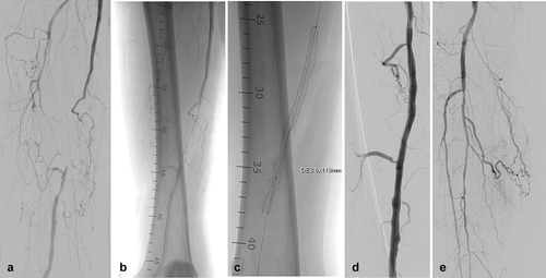 Figure 4. EluviaTM stent implantation in the MAJESTIC study. The female patient was 73 years old and a current smoker with 100% occluded lesion in the mid-SFA with severe calcification. (A) Baseline angiography of the SFA shows the occlusion of nearly 9 cm in length. (B) Unsubtracted angiography indicates an intraluminal 0.018-inch guidewire crossing. (C) Fluoroscopic view of a 6 x 119 mm EluviaTM stent. Note the vessel wall calcification located in the mid- and distal part of the successfully treated lesion. (D) Final angiography represents a good technical result without any significant residual stenosis. (E) The run-off is non-compromised and does not show any signs of distal embolization.