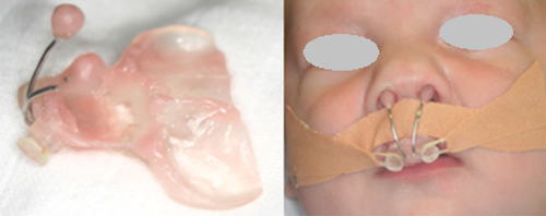 Figure 1. Nasoalveolar moulding device (left) and attachment of device on patient (right).