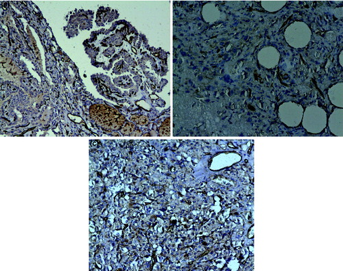 Figure 2. Microvessel density (MVD) in thyroid tissue: (a) CD31-positive vessels in a papillary thyroid cancer (×100 magnification); (b) CD31 staining in blood vessels in anaplastic thyroid cancer (×200 magnification); (c) CD31 staining in blood vessels in follicular thyroid cancer (×200 magnification).