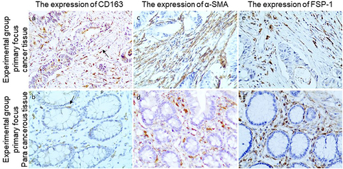 Figure 1 Representative immunohistochemical staining of CD163, α-SMA, and FSP-1 in the experimental group’s primary focal cancer and paracancerous tissues (200x field). (a) Expression of CD163 in primary focus cancer tissues of the experimental group (Arrows mark M2-type macrophages). (b) Expression of CD163 in paracarcinoma tissues of primary foci in the experimental group (Arrows mark M2-type macrophages). (c) Expression of α-SMA in primary focal cancer tissues of the experimental group. (d) Expression of α-SMA in primary foci of paracancerous tissues in the experimental group. (e) Expression of FSP-1 in primary foci cancer tissues of the experimental group. (f) Expression of FSP-1 in primary foci of paracarcinoma tissues in the experimental group.