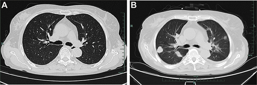 Figure 1 Chest CT images of the patient. (A) Chest CT on December 27, 2021. (B) Chest CT imaging on December 29, 2021.