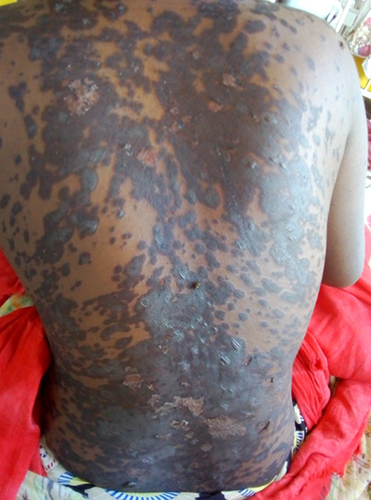 Figure 3 Shows skin lesions developed at the fifth day of initiation of misoprostol tablet.