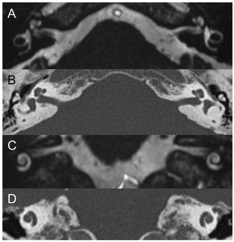 Figure 2. Preoperative MRI (A, axial; C, coronal) and CT (B, axial; D, coronal) showed normal cochlear and vestibular fluid spaces, with no imaging evidence of labyrinthitis. Specifically, MRI showed no abnormal obliteration, signal change, or contrast enhancement of fluid spaces, and CT did not show ossification.