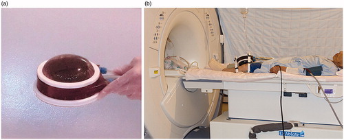 Figure 1. (a) Conformal sonication transducer with semipermeable membrane-covered ball. (b) Patient with transducer secured to the medial side of the left knee with a strap.