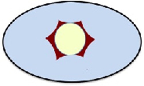 Figure 2 The illustration displays severe pneumoconjunctiva with lots of subconjunctival air (light blue color) covering the peripheral cornea and blocking diffusion of suprachoroidal air through the gap of the sutured sclerotomies (brown color: iris, light yellow color: pupil).