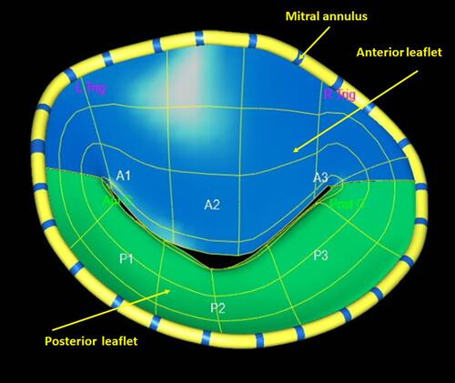 Figure 1 Mitral anatomy model. Viewed from the left atrium (Surgeon’s View). Anterior (A), Posterior (P) leaflet scallops numbered from 1–3, from lateral to medial.