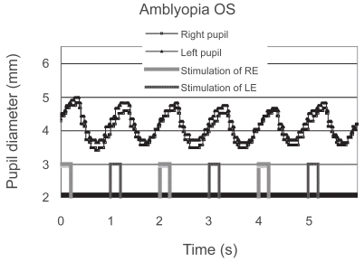 Figure 5 Pupillographic tracings of a 10-year-old girl with anisometropic and strabismic amblyopia OS. The visual acuity was 20/100 in the left eye. The contraction amplitudes were similar regardless of the eye stimulated.