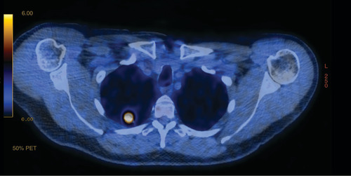 Figure 2. PET-computed tomography showing fluorodeoxyglucose-avidity of right upper lobe nodule shown in Figure 1 with no evidence of lymphadenopathy or metastatic disease.