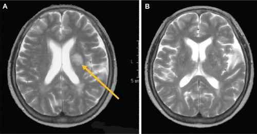 Figure 1 Axial T2-weighted magnetic resonance imaging (MRI) of the body of the lateral ventricle showing a single infarction in the left corona radiata.
